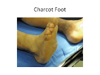 Houston podiatrist treats diabetic foot ulcers and charcot 