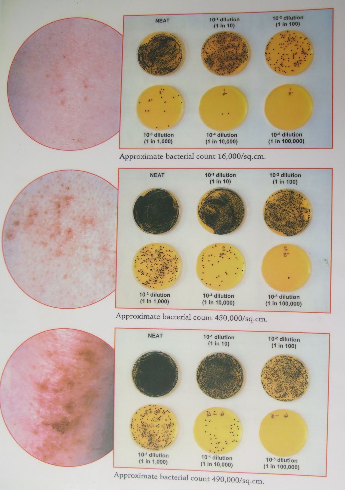 eczema staph infection