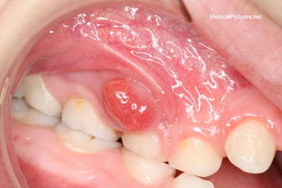 tooth abscess tooth abscess pictures tooth abscess tooth abscess pictures