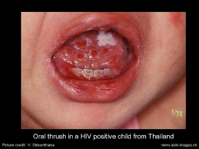 Symptom Hiv