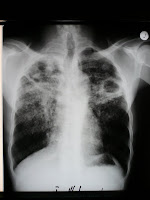 kans op hiv prostitutie