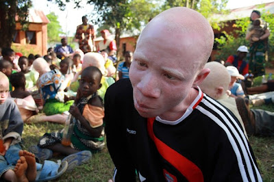 black albino kid