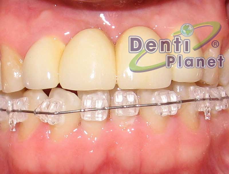 Blog Ortodoncia ¿Se pueden colocar brackets solo arriba o