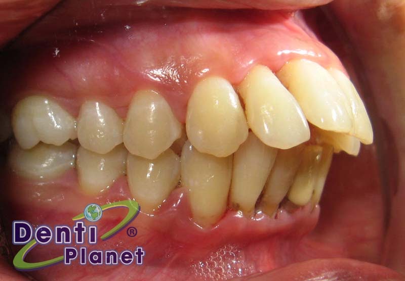 Blog Ortodoncia ¿Puedo colocarme brackets si se me mueven