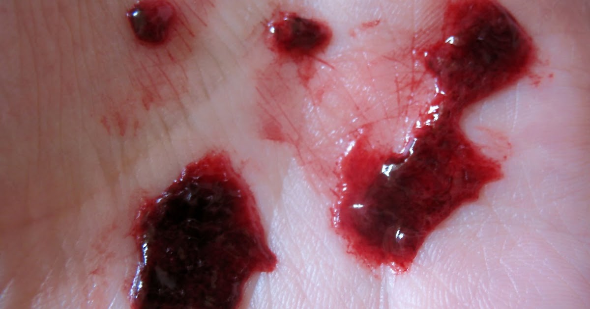 A Sibling for You: Endometrial lining...again...