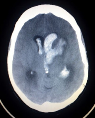 Stroke+ct+scan+images