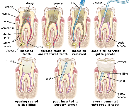 [root-canal-therapy.gif]