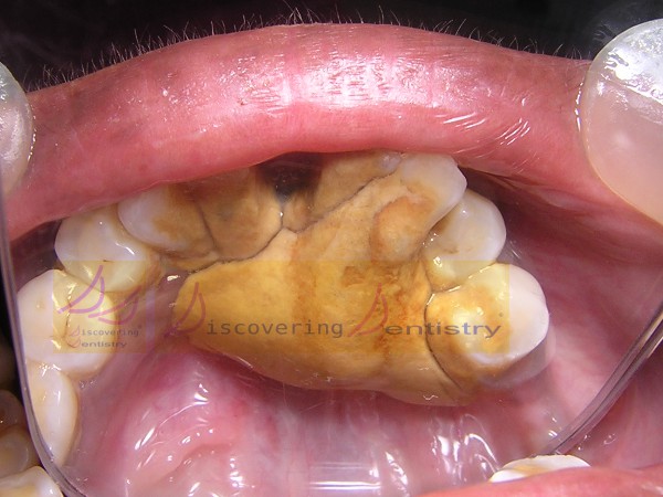 Discovering Dentistry: Worlds Largest Dental Calculus Weighing 2850 mg