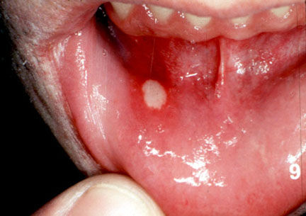 stomatitis