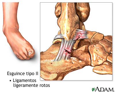 Esguince Tipo II