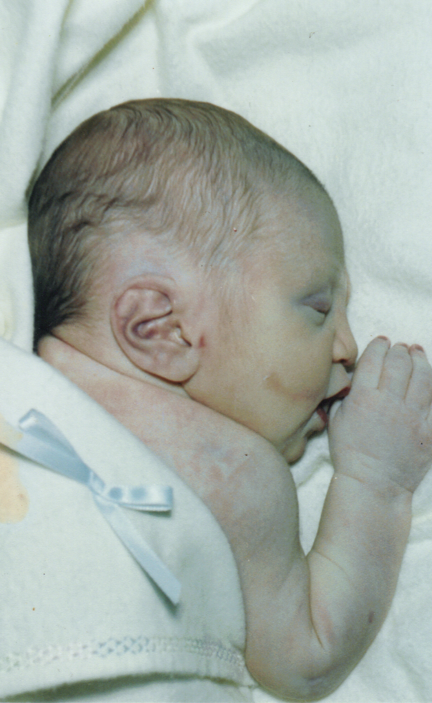 Potter's Syndrome December 2010