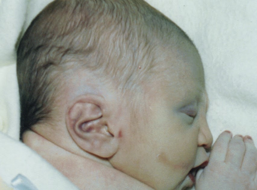 Potter's Syndrome To my Christian, the child in our hearts