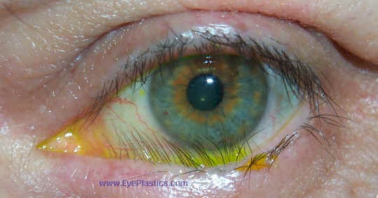 psoriasis i ögat