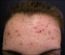 2 weeks of skin b5 acne relief