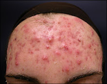 Before skin b5 acne relief