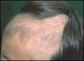 Hair Loss Treatment