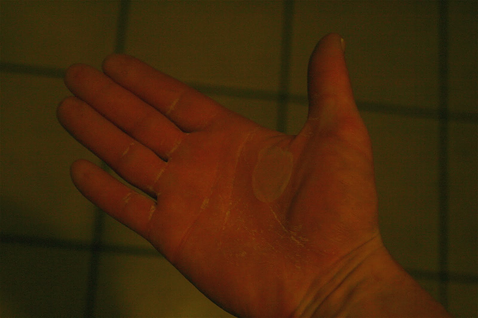 Blistered Sunburn