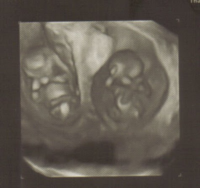I was pregnant with twins.
