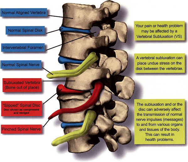 [Subluxation_image.gif]