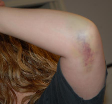 [broken-elbow.jpg]