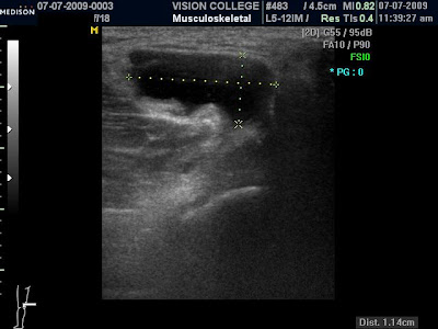 Left knee effusion and 2011