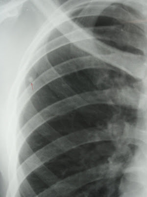 Granuloma Lung