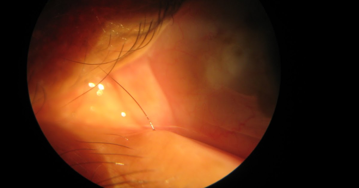 Take Care Of Your Eyes Eyelash stuck in punctum of lower lid of the eye.