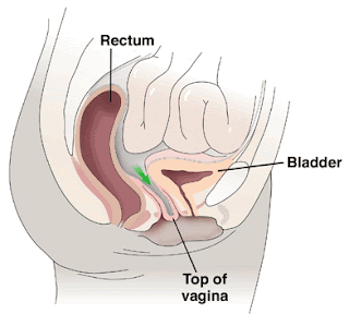 sex after a vaginal hysterectomy hoes shaking their ass