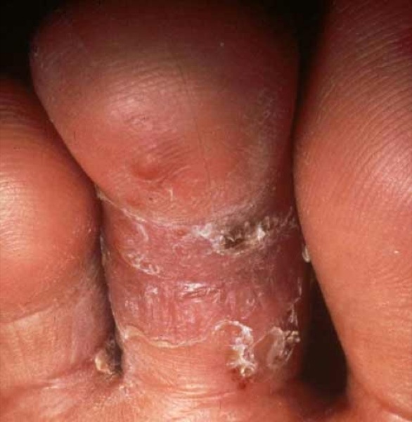 Fungo entre pernas em um tratamento de virilha