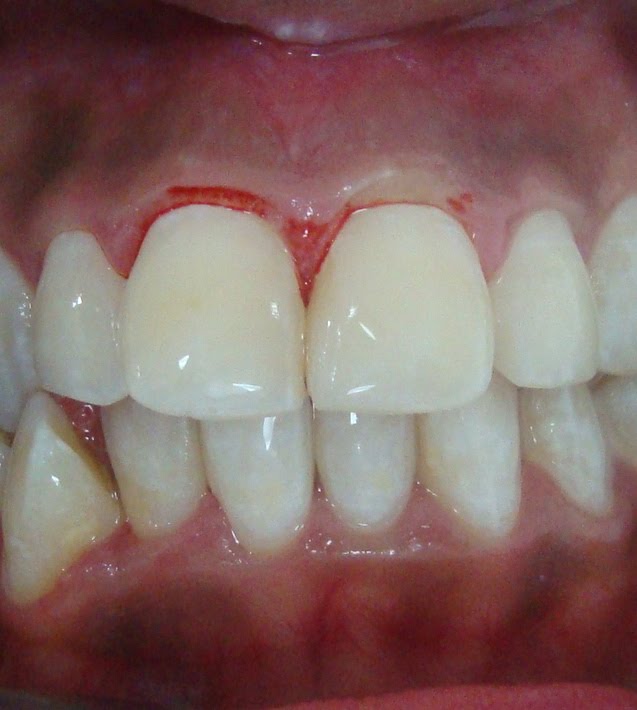 Odontología al Día MICROABRASIÓN DEL ESMALTE