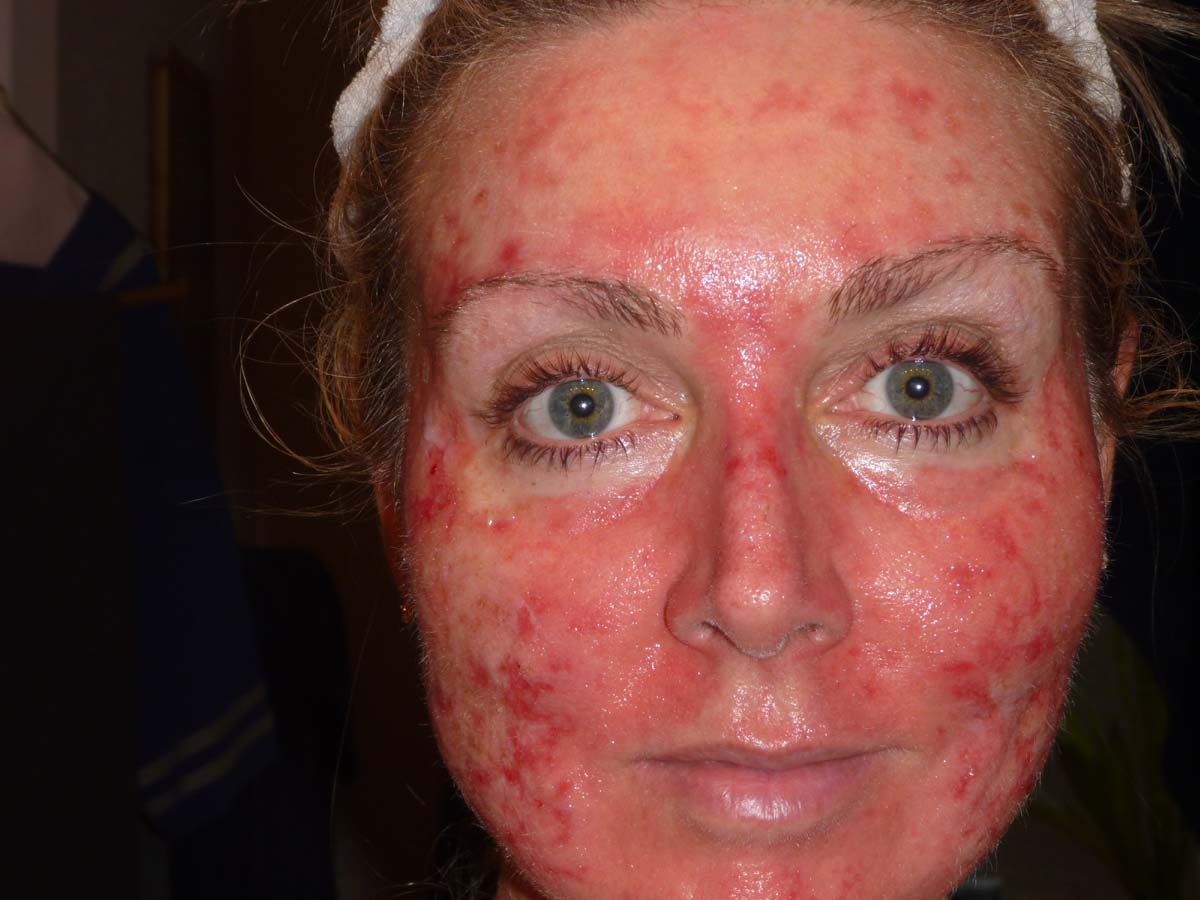 Pam's Efudex Blog Day 2730 November 2225, 2010