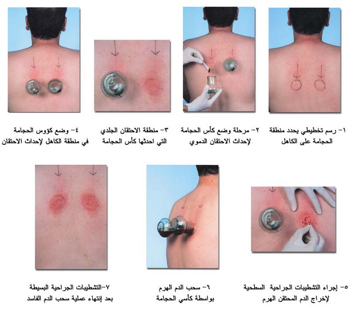 تأمل خطبة أقرض كم عدد كاسات الحجامه في السنه rosedalemasterplan com