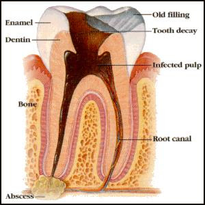 Tooth Abscess Toward Critical Stage