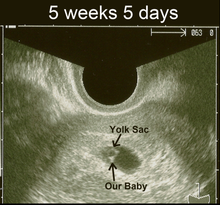 sonogram 5 weeks. 12 5 week ultrasound.