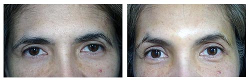 [BrowLiftBeforeAndAfter.jpg]