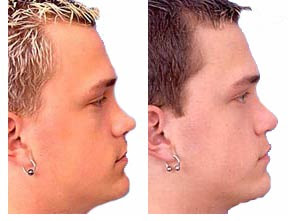 Rhinoplasty Before And After