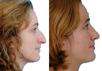 [Nose++JobBeforeAndAfter.jpg]