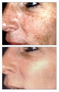 Microdermabrasion Before And After