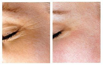 Microdermabrasion Before And After