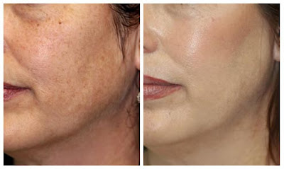 Bad+microdermabrasion