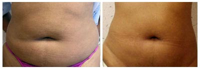 Mesotherapy Before After