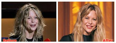 Meg Ryan Plastic Surgery Before After
