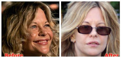 Meg Ryan Plastic Surgery Before After
