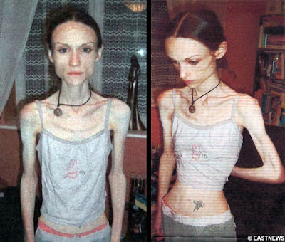 Anorexic Beauty