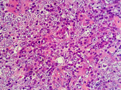 HISTOPATHOLOGY: Axillary Lymph Node (15)