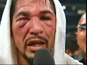 Eye Socket Fracture Faces After Fights-1.bp.blogspot.com