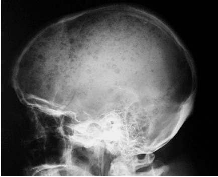 Multiple Myeloma Skull X Ray. Foto skull lateral yang