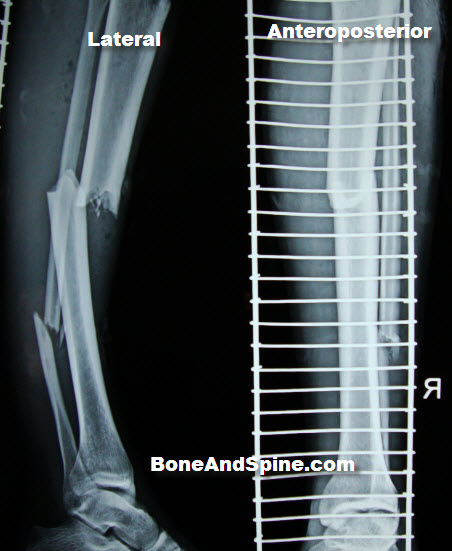 Right Tibia Fracture