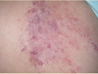 How To Clear Up Contact Dermatitis TREATMENT%2BFOR%2BECZEMA How To Clear Up Contact Dermatitis