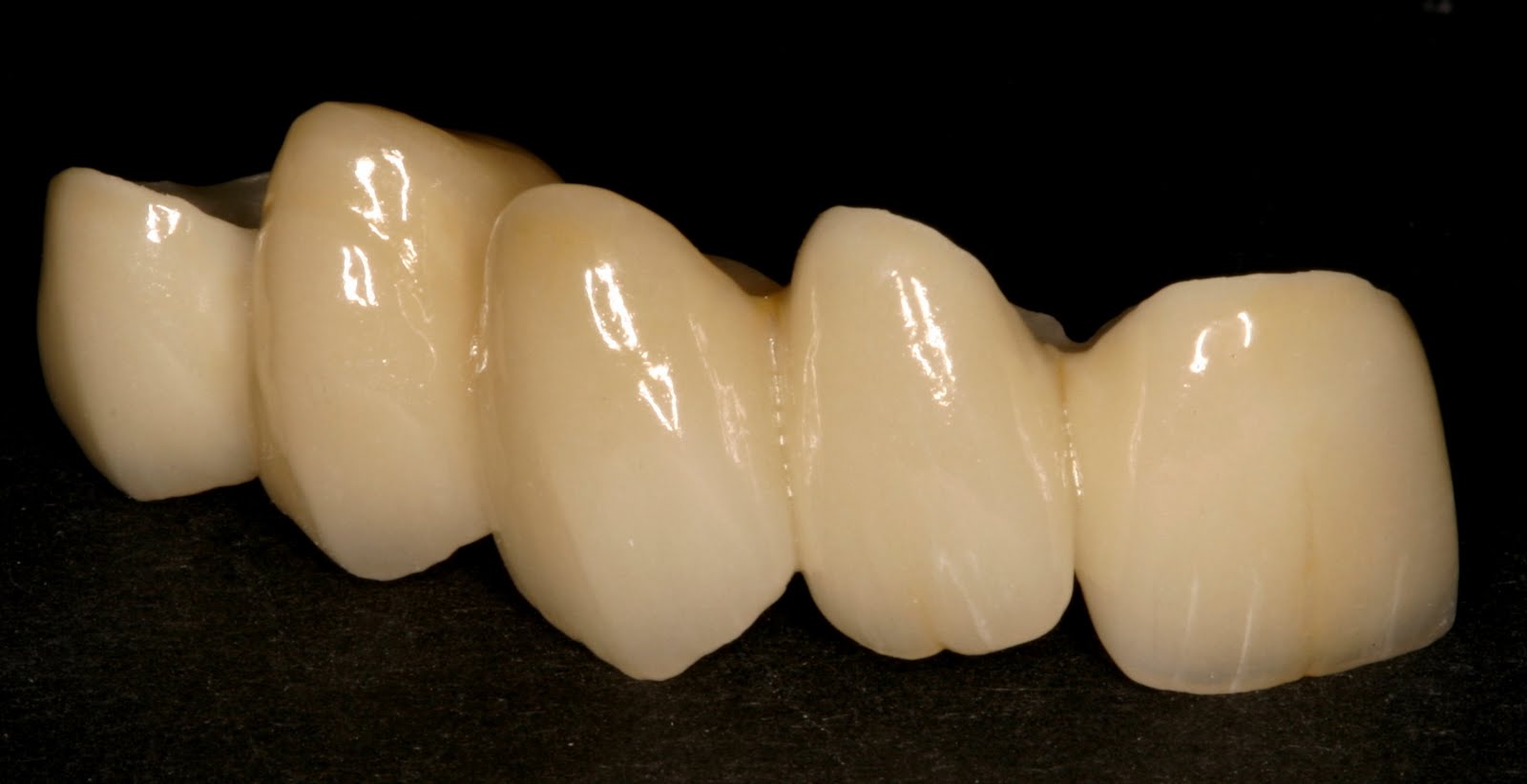 Beautiful Smiles Zirconia AllCeramic Bridge